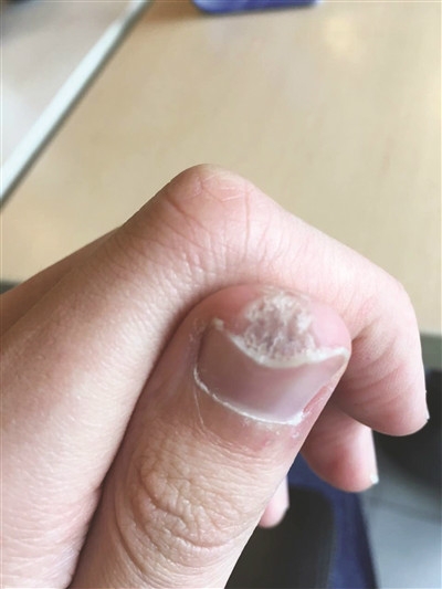 跖疣到底是一种什么病有没有治疗的办法